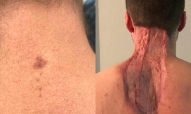 Η “αθώα” ελιά 37χρονου αποδείχτηκε μελάνωμα – Του έκοψαν 40 εκ. δέρματος για να σωθεί – Εικόνες σοκ!